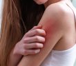 Punaises de lit et soins de la peau : que faire en cas de piqûres ?