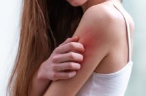 Punaises de lit et soins de la peau : que faire en cas de piqûres ?