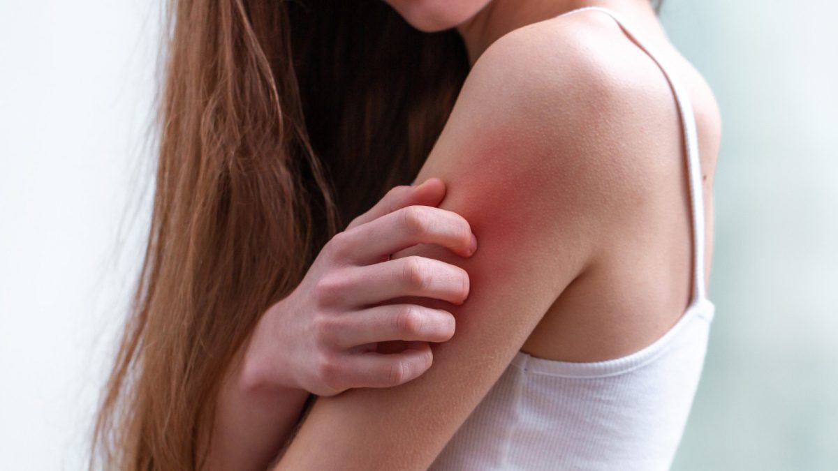 Punaises de lit et soins de la peau : que faire en cas de piqûres ?
